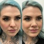 Beautiful results only 2 months after rhinoplasty and chin implant !