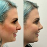 Beautiful results only 2 months after rhinoplasty and chin implant !