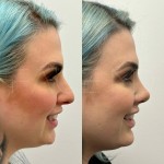 Beautiful results only 2 months after rhinoplasty and chin implant !