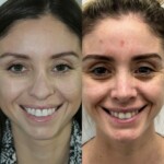 3 months after rhinoplasty and chin implant, healing beautifully!
