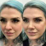 Beautiful results only 2 months after rhinoplasty and chin implant !