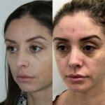 3 months after rhinoplasty and chin implant, healing beautifully!