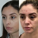 3 months after rhinoplasty and chin implant, healing beautifully!
