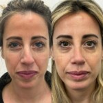 beautiful patient 1 year post rhinoplasty and chin implant