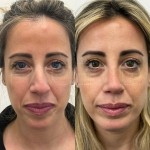 beautiful patient 1 year post rhinoplasty and chin implant