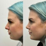 Beautiful results only 2 months after rhinoplasty and chin implant !