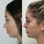 3 months after rhinoplasty and chin implant, healing beautifully!
