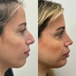 beautiful patient 1 year post rhinoplasty and chin implant