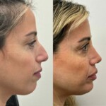 beautiful patient 1 year post rhinoplasty and chin implant