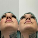 Beautiful results only 2 months after rhinoplasty and chin implant !
Scars healing beautifully.