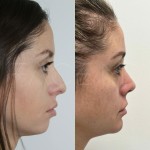 3 months after rhinoplasty and chin implant, healing beautifully!