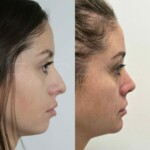 3 months after rhinoplasty and chin implant, healing beautifully!