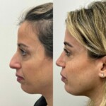 beautiful patient 1 year post rhinoplasty and chin implant