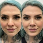 Beautiful results only 2 months after rhinoplasty and chin implant !