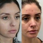 3 months after rhinoplasty and chin implant, healing beautifully!