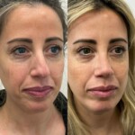 beautiful patient 1 year post rhinoplasty and chin implant
