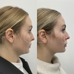 Source: Dr. Moubayed’s practice. Not a guarantee of results. Photos published with informed written consent of patients Female treated with Evoke to neck (Source: Clinique Face MD)