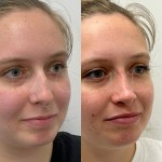 Beautiful results after only 8 months after ultrasonic rhinoplasty