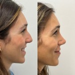 Incredible result only 2 months after ultrasonic rhinoplasty on our happy patient.