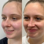Beautiful results after only 8 months after ultrasonic rhinoplasty