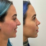 6 months after ultrasonic rhinoplasty on beautiful patient