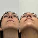 Incredible result only 2 months after ultrasonic rhinoplasty on our happy patient.
