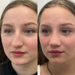 Only 4 months after an ultrasonic rhinoplasty, beautiful results !