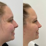 Beautiful results after only 8 months after ultrasonic rhinoplasty