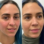 6 months after ultrasonic rhinoplasty on beautiful patient
