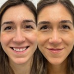 Incredible result only 2 months after ultrasonic rhinoplasty on our happy patient.