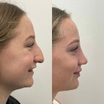 Only 4 months after an ultrasonic rhinoplasty, beautiful result !