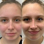 Beautiful results after only 8 months after ultrasonic rhinoplasty