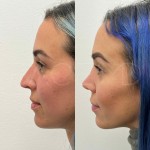 6 months after ultrasonic rhinoplasty on beautiful patient