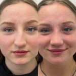 Only 4 months after an ultrasonic rhinoplasty, beautiful result!