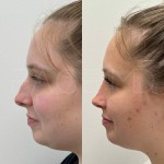 Beautiful results after only 8 months after ultrasonic rhinoplasty