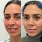 6 months after ultrasonic rhinoplasty on beautiful patient