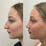 Only 4 months after an ultrasonic rhinoplasty, beautiful result!