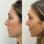 Incredible result only 2 months after ultrasonic rhinoplasty on our happy patient.