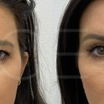 Source: Dr. Moubayed’s practice. Not a guarantee of results. Photos published with informed written consent of patients Female treated with Temporal Fox Eye lift