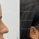 Source: Dr. Moubayed’s practice. Not a guarantee of results. Photos published with informed written consent of patients Female treated with Temporal Fox Eye lift