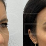 Source: Dr. Moubayed’s practice. Not a guarantee of results. Photos published with informed written consent of patients Female treated with Temporal Fox Eye lift