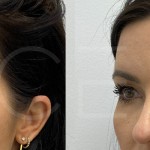 Source: Dr. Moubayed’s practice. Not a guarantee of results. Photos published with informed written consent of patients Female treated with Temporal Fox Eye lift
