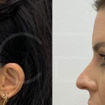 Source: Dr. Moubayed’s practice. Not a guarantee of results. Photos published with informed written consent of patients Female treated with Temporal Fox Eye lift