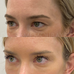 Source: Dr. Moubayed’s practice. Not a guarantee of results. Photos published with informed written consent of patients Female treated with Temporal Fox Eye lift and Upper Blepharoplasty