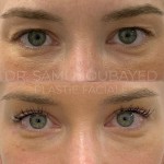 Source: Dr. Moubayed’s practice. Not a guarantee of results. Photos published with informed written consent of patients Female treated with Temporal Fox Eye lift and Upper Blepharoplasty