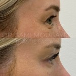 Source: Dr. Moubayed’s practice. Not a guarantee of results. Photos published with informed written consent of patients Female treated with Temporal Fox Eye lift and Upper Blepharoplasty