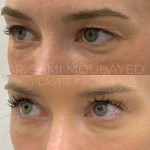 Source: Dr. Moubayed’s practice. Not a guarantee of results. Photos published with informed written consent of patients Female treated with Temporal Fox Eye lift and Upper Blepharoplasty