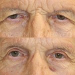 Source: Dr. Moubayed’s practice. Not a guarantee of results. Photos published with informed written consent of patients Male treated with endoscopic brow lift and upper blepharoplasty