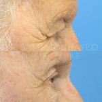 Source: Dr. Moubayed’s practice. Not a guarantee of results. Photos published with informed written consent of patients Male treated with endoscopic brow lift and upper blepharoplasty