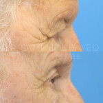 Source: Dr. Moubayed’s practice. Not a guarantee of results. Photos published with informed written consent of patients Male treated with endoscopic brow lift and upper blepharoplasty